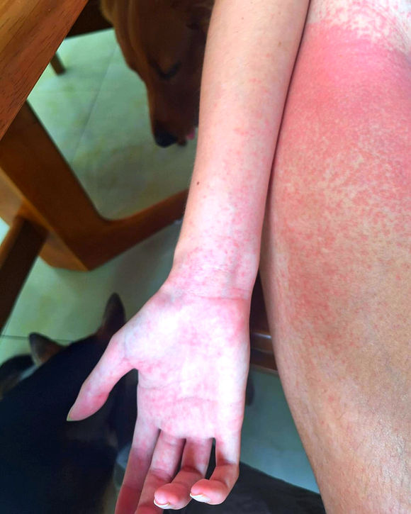 Chemical burn from laundry detergent